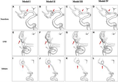 Hemodynamic Effects of Stent-Induced Straightening of Parent Artery vs. Stent Struts for Intracranial Bifurcation Aneurysms